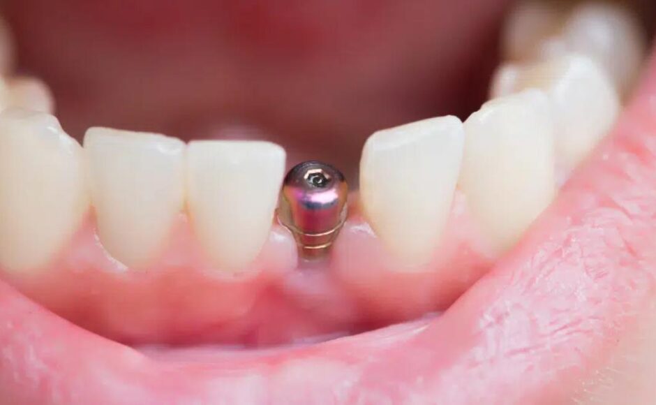 implants dentaires